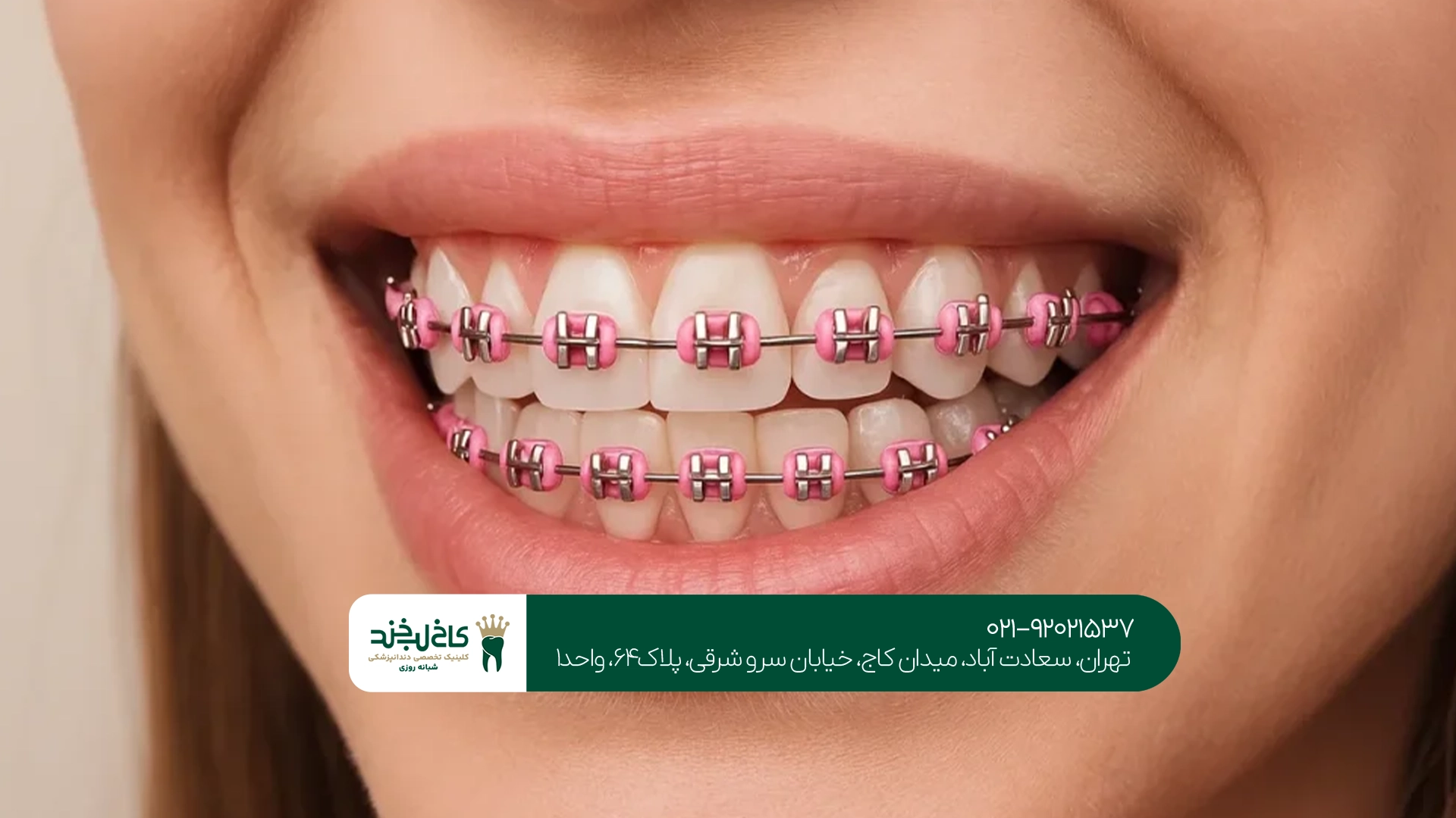 سیم کشی دندان برای کودکان سیم کشی دندان برای کودکان