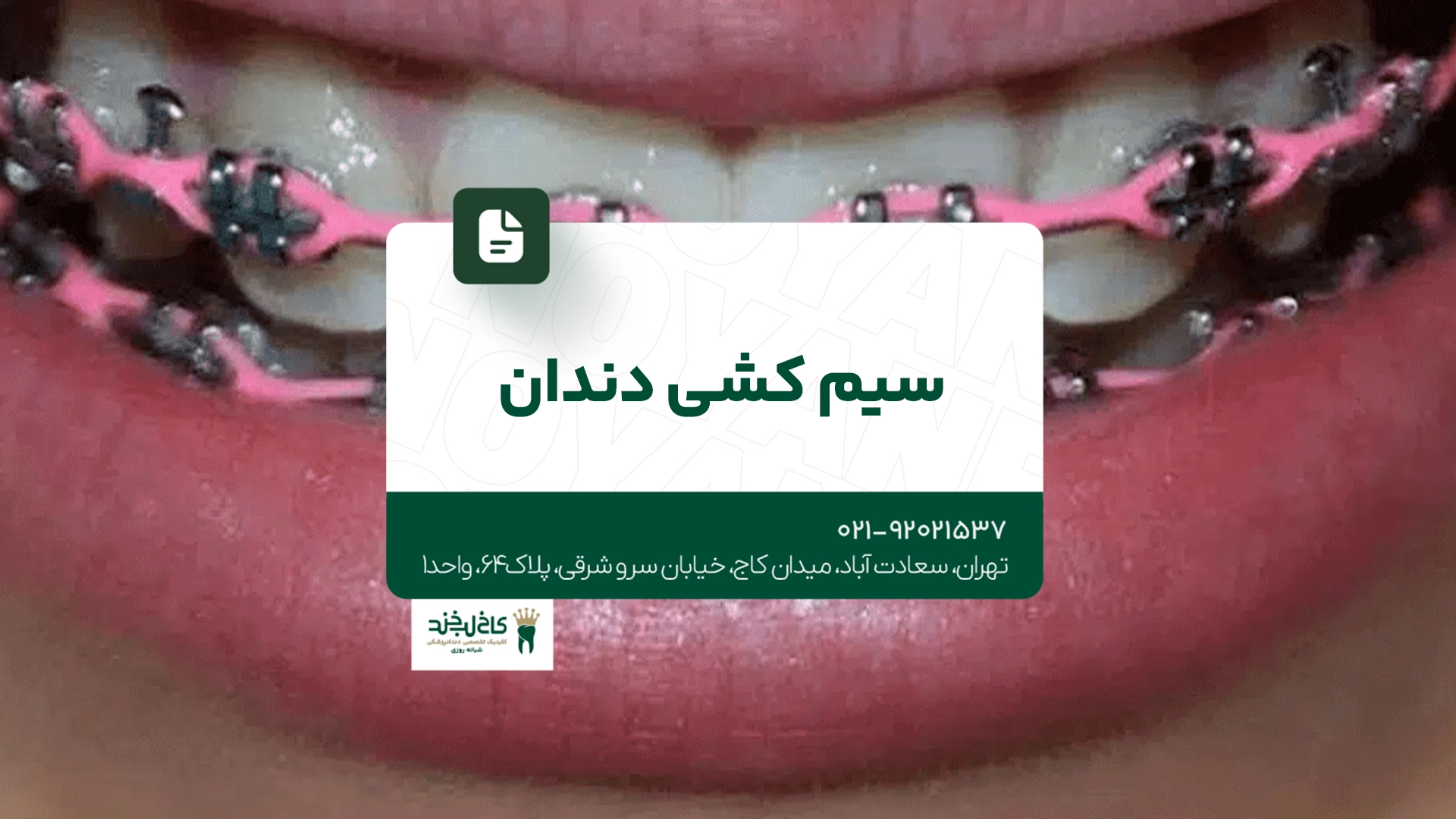 سیم کشی دندان سیم کشی دندان