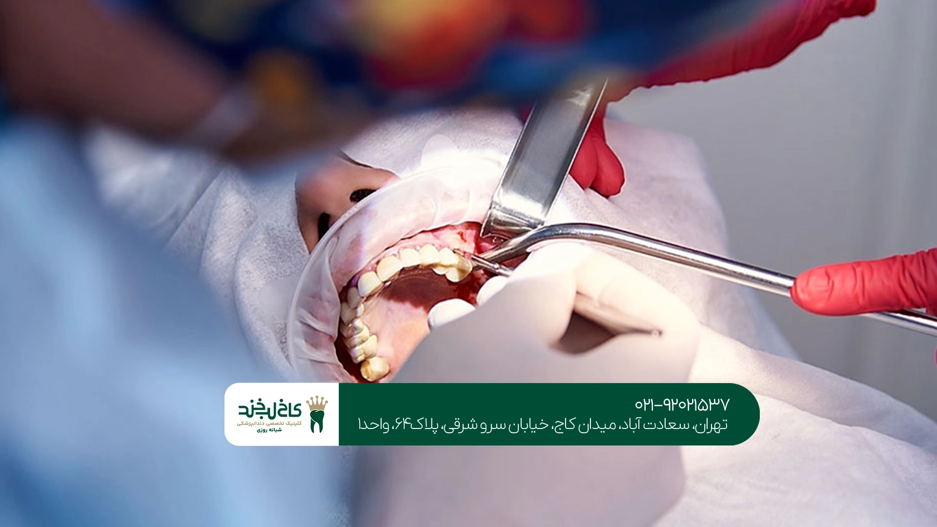 هزینه سینوس لیفت در تهران هزینه سینوس لیفت در تهران