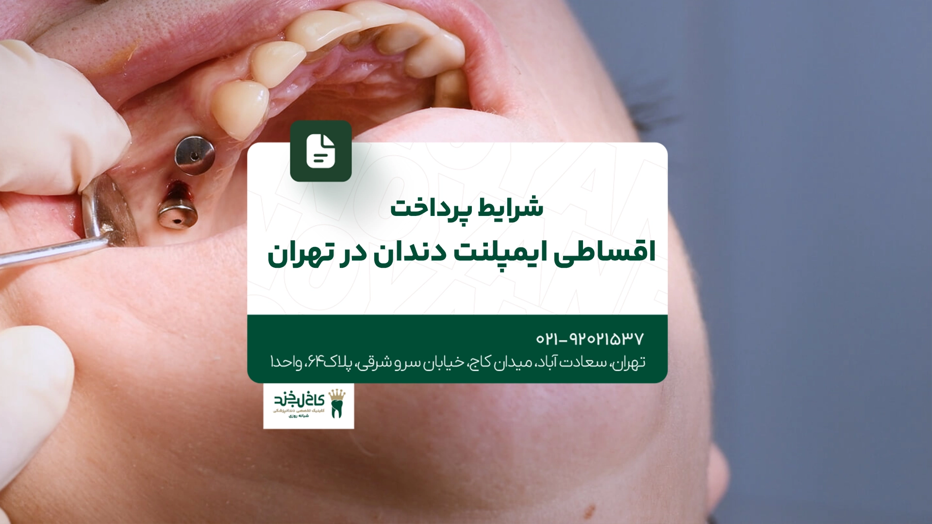 شرایط پرداخت اقساطی ایمپلنت در تهران شرایط پرداخت اقساطی ایمپلنت در تهران