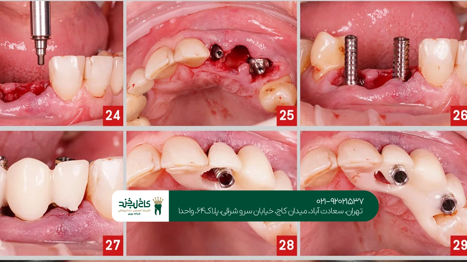 مزایای ایمپلنت دندان اقساطی مزایای ایمپلنت دندان اقساطی