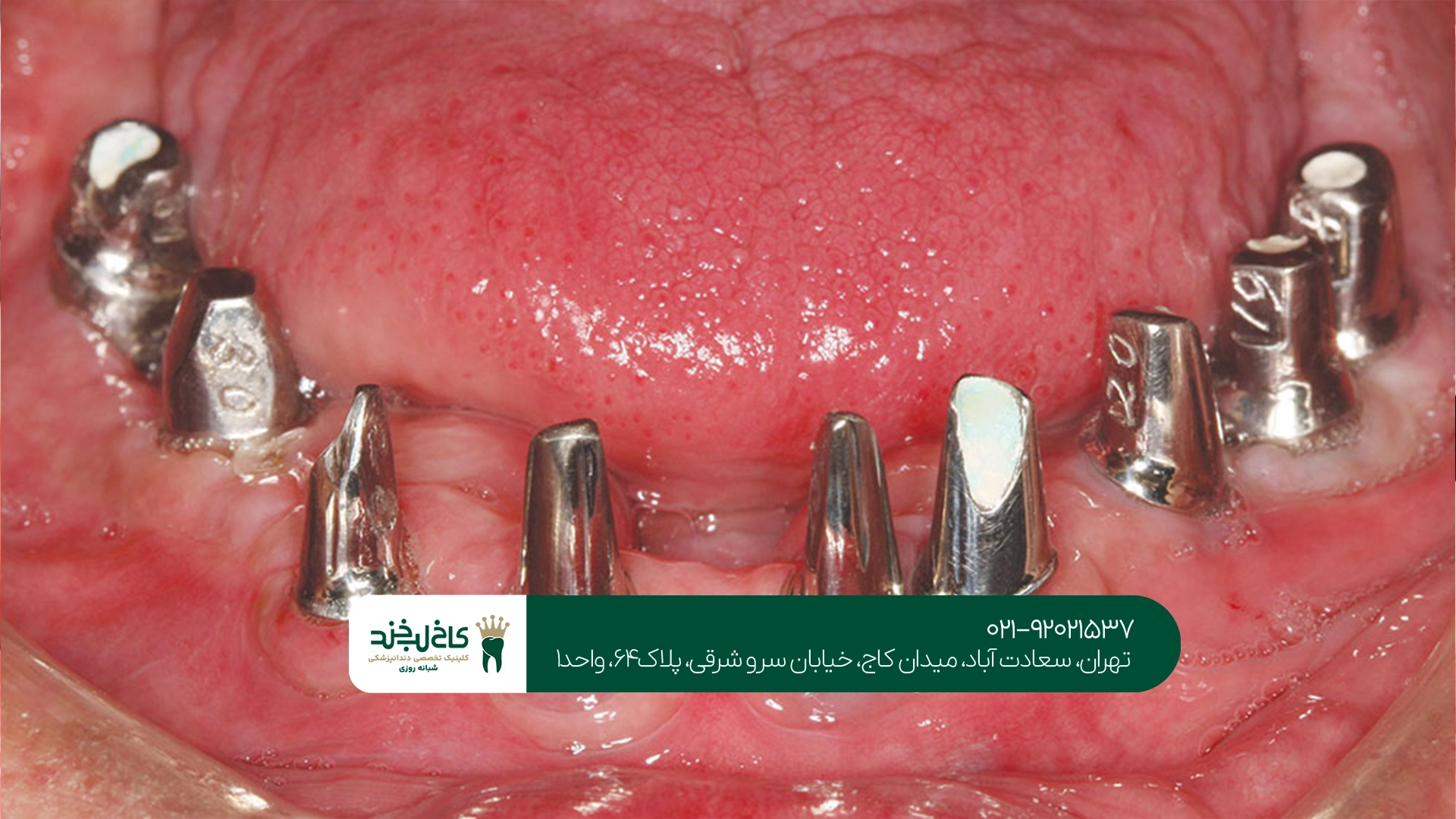 شرایط پرداخت اقساطی ایمپلنت شرایط پرداخت اقساطی ایمپلنت
