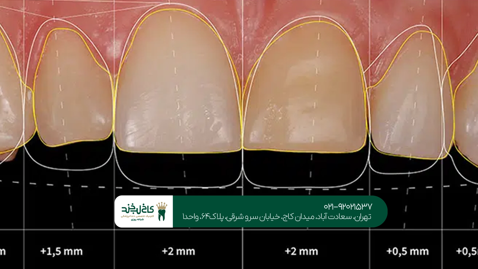 مزایای طراحی دیجیتال لبخند دندان