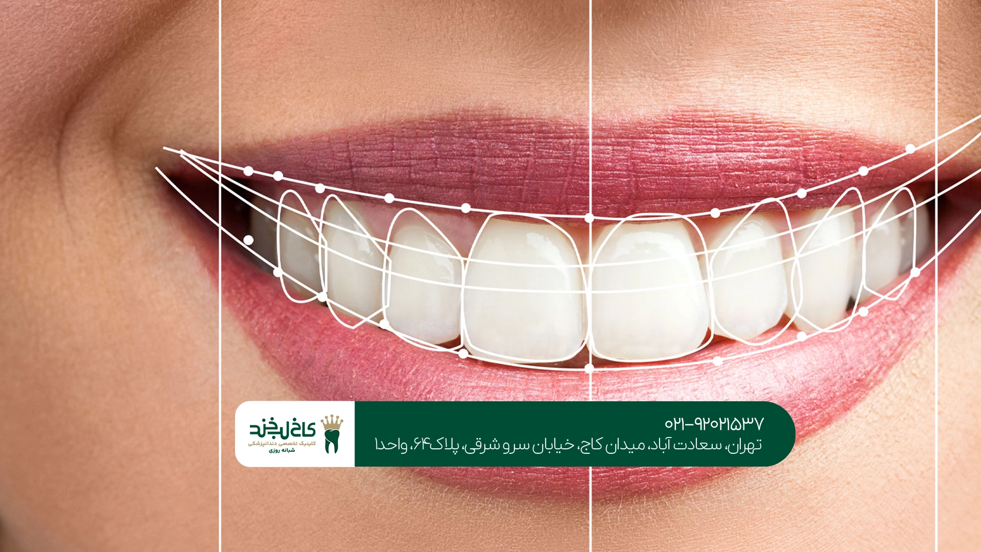 طراحی دیجیتال لبخند برای کامپوزیت دندان