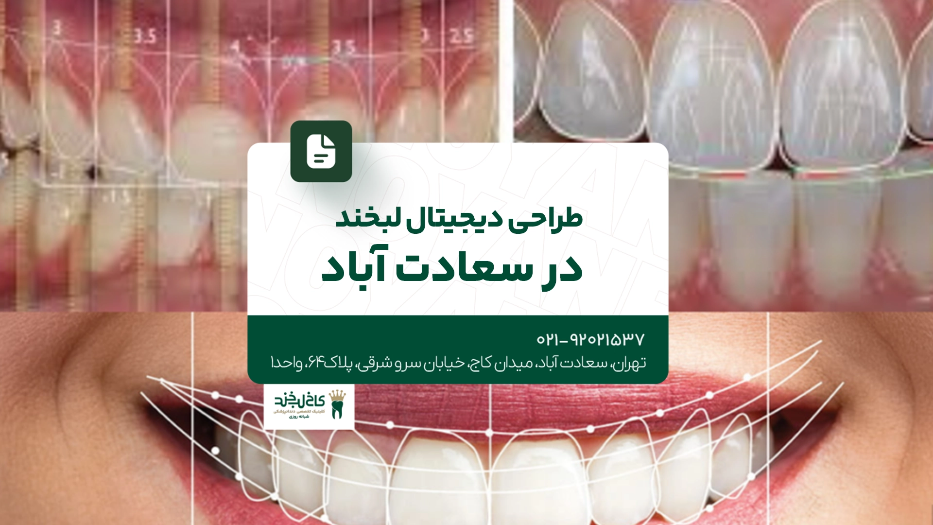 طراحی دیجیتال لبخند در سعادت آباد
