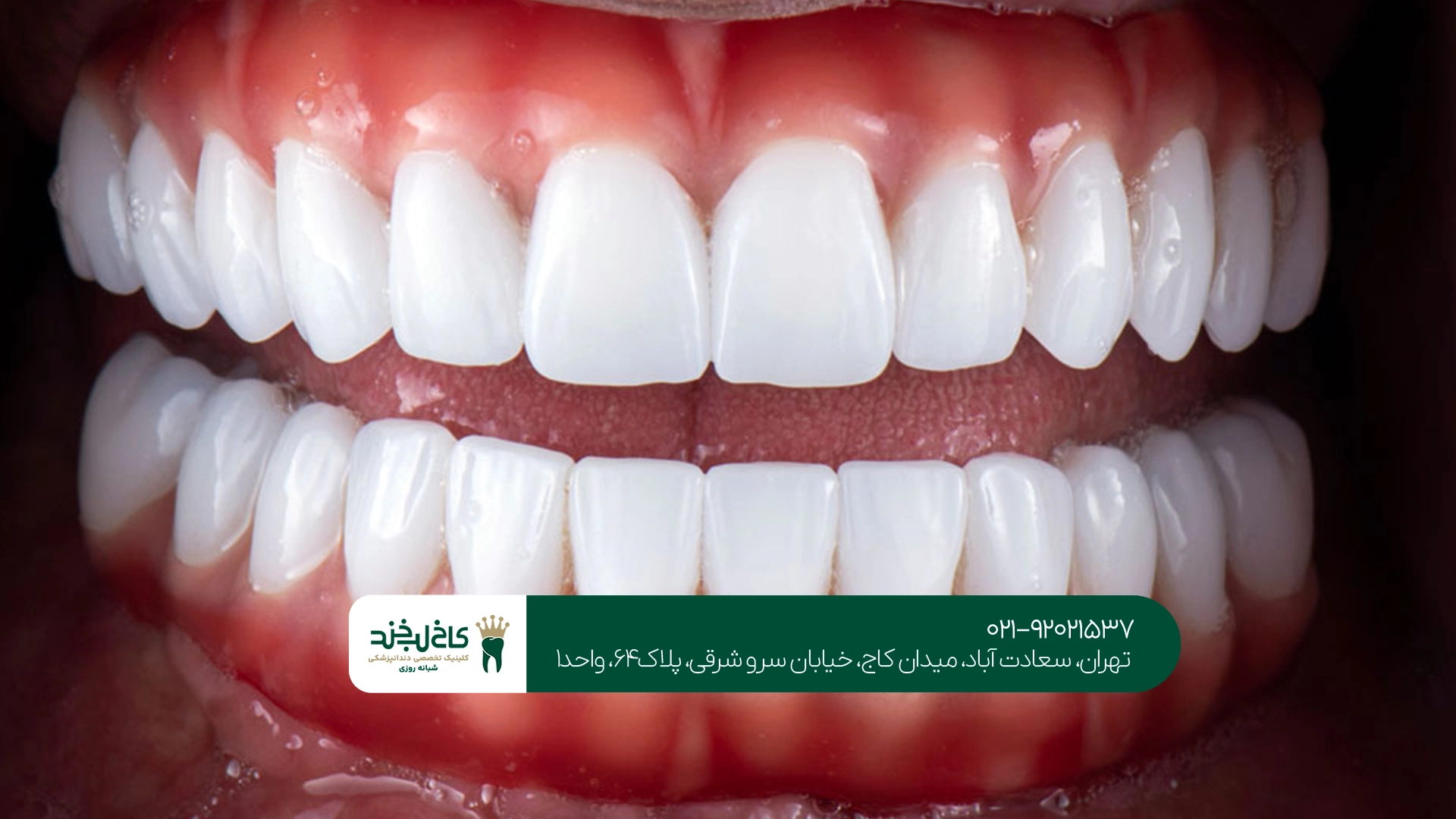 تفاوت ماندگاری لمینت سرامیکی و کامپوزیت دندان