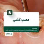 عصب کشی