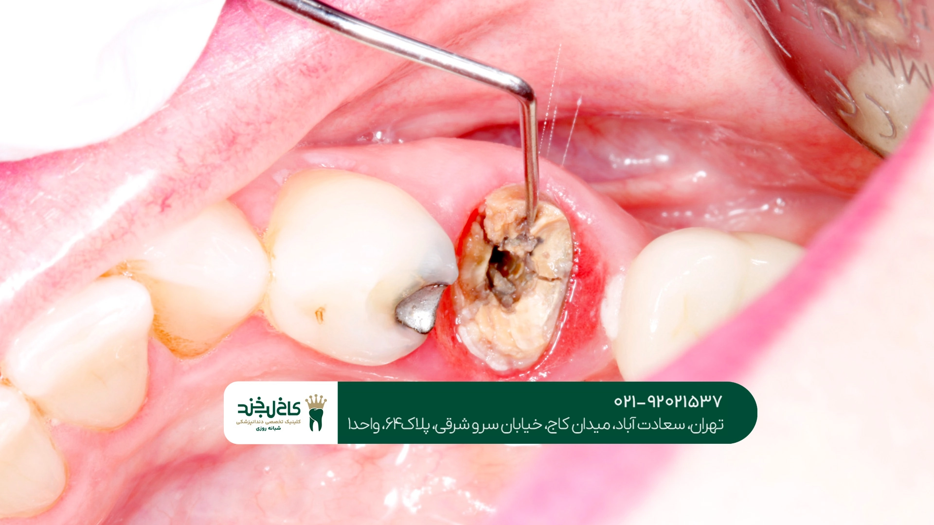 عصب کشی تخصصی عصب کشی تخصصی