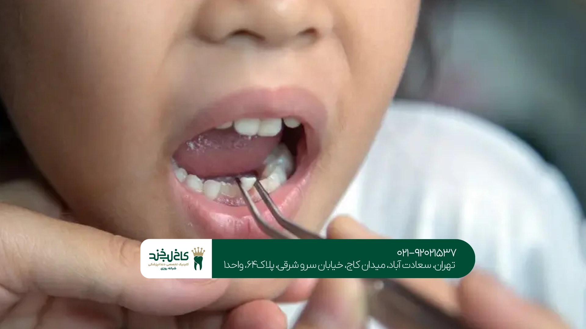 تفاوت عصب کشی دندان شیری و دائمی
