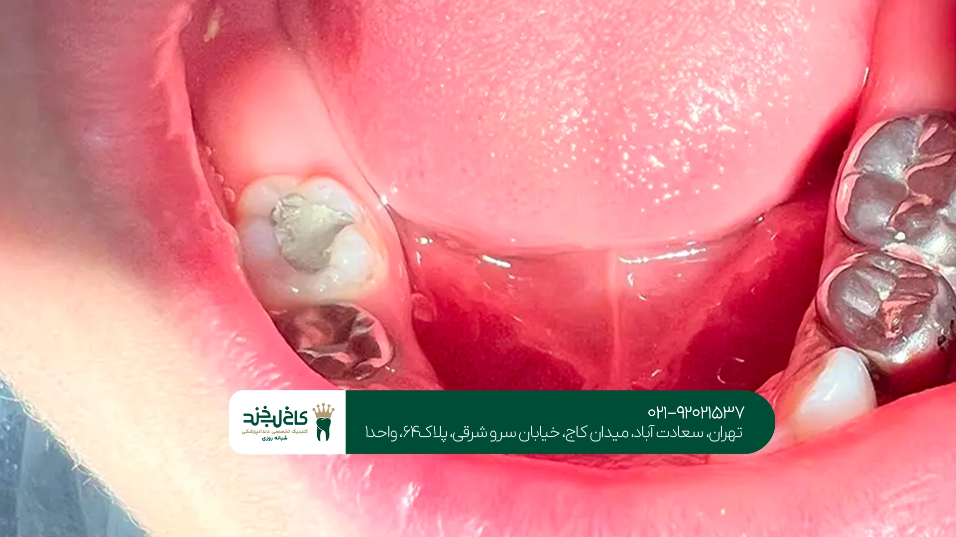 علائم نیاز به عصب کشی دندان شیری