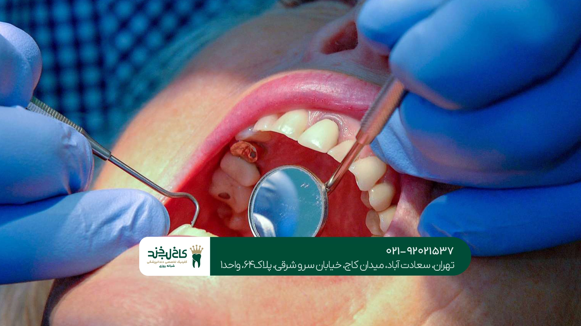 مراقبت بعد از عصب کشی دندان مراقبت بعد از عصب کشی دندان
