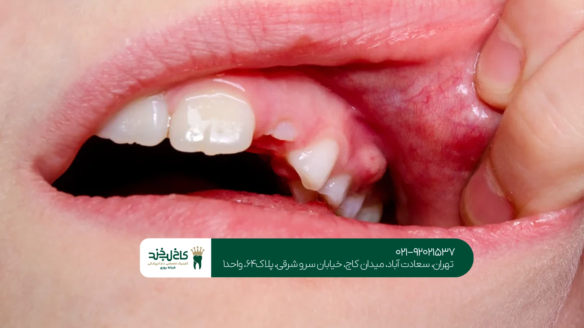 کلینیک درمان عفونت ریشه دندان