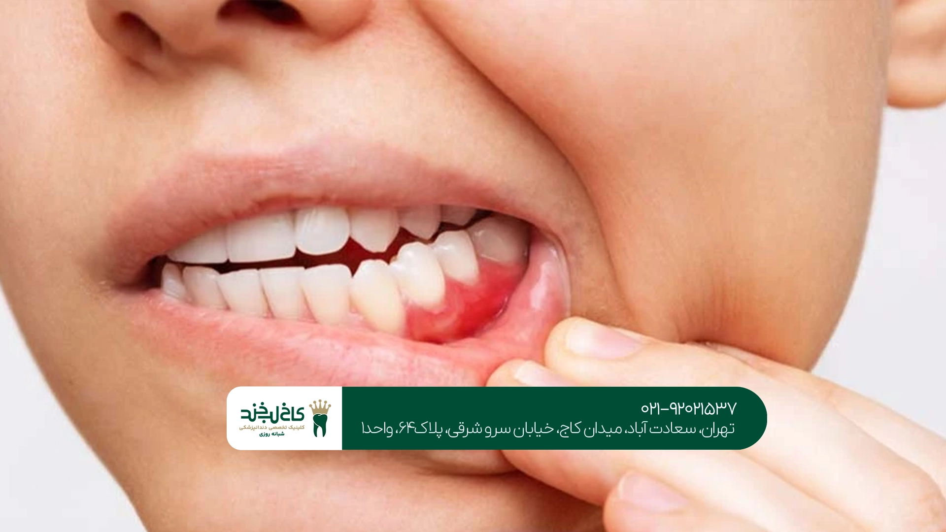 عفونت لثه چه عوارضی برای دندانها دارد؟