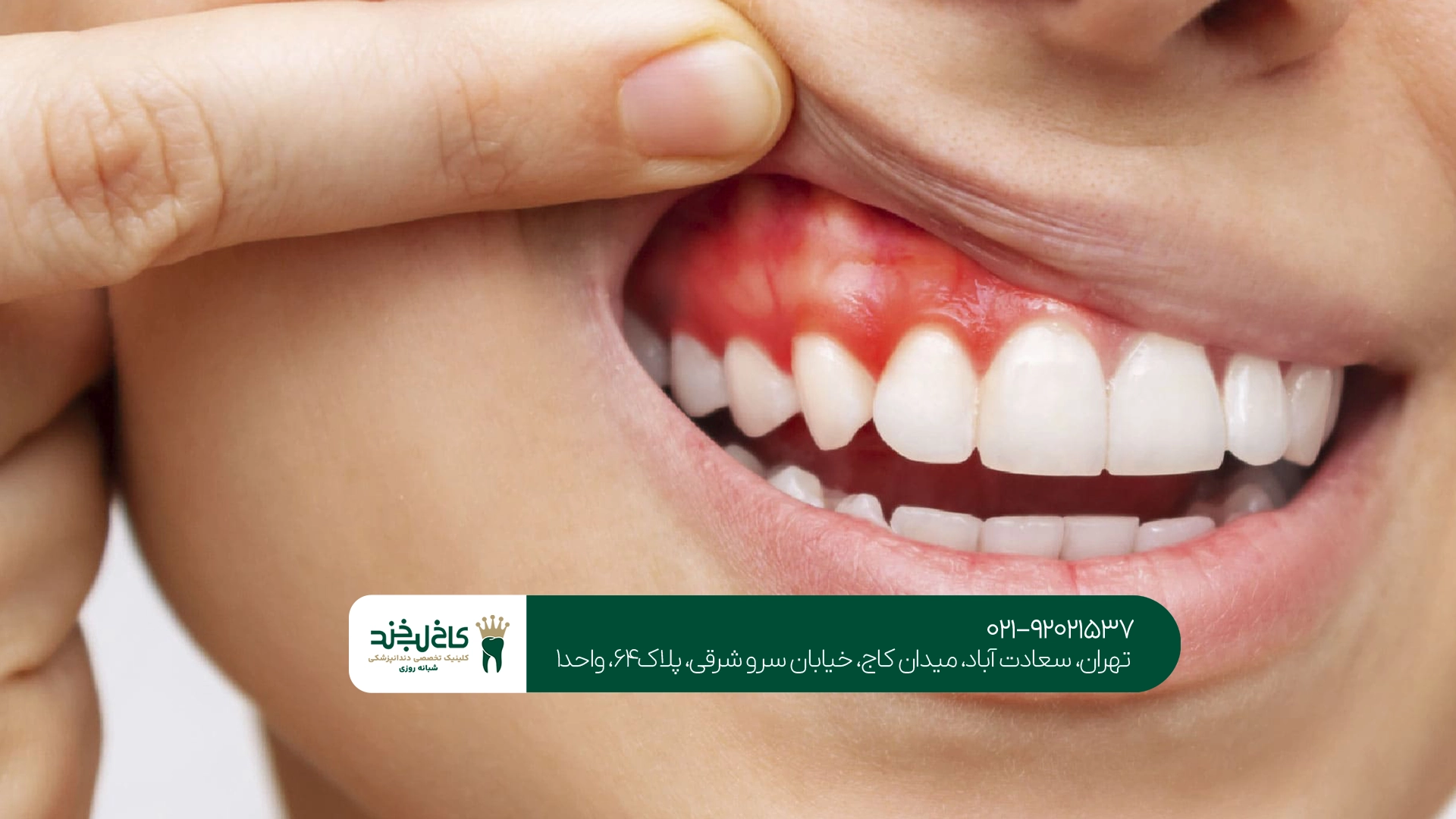 بهترین دکتر عفونت لثه