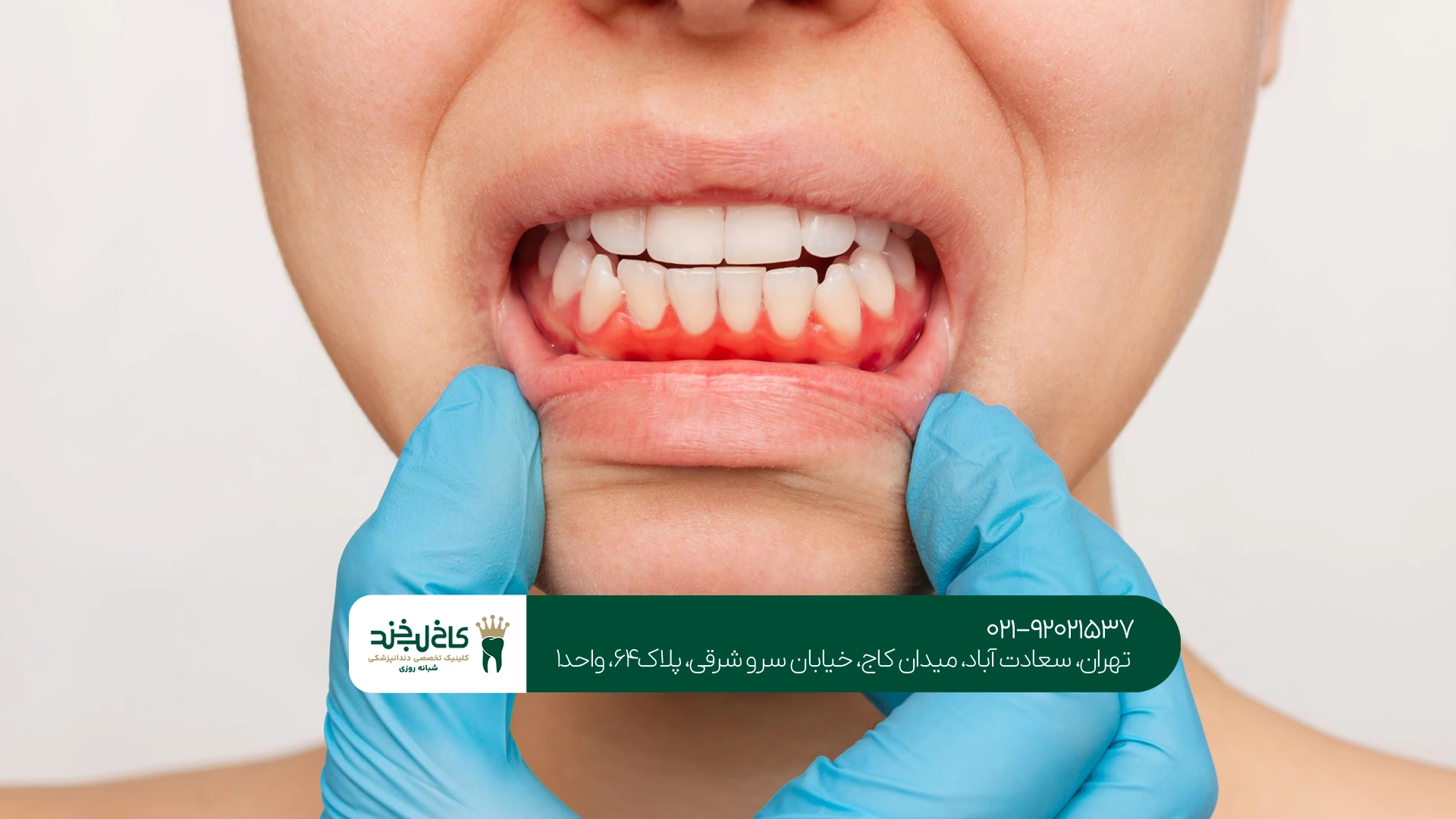 عفونت شدید لثه