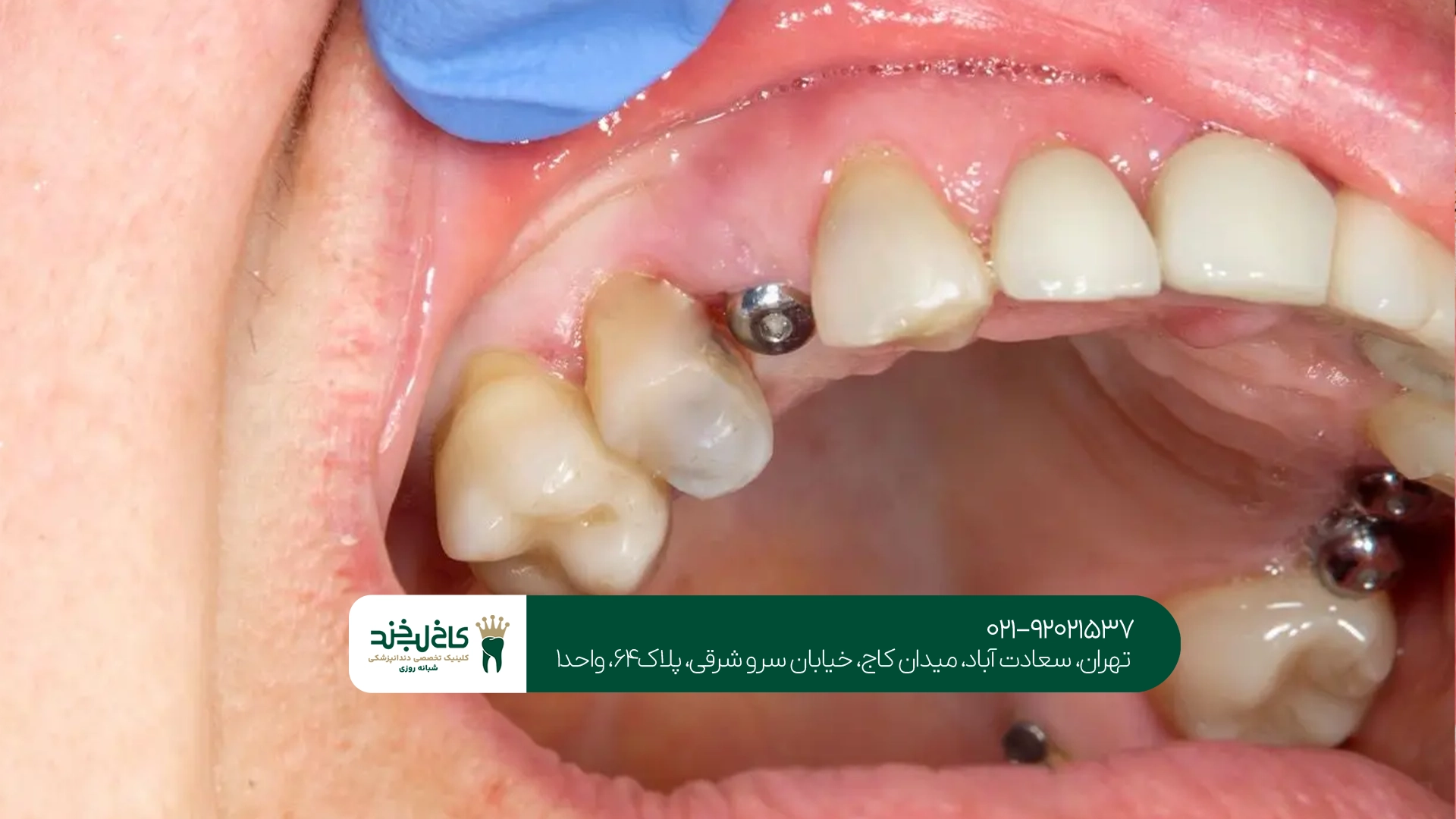 بهترین کلینیک ایمپلنت دندان در تهران بهترین کلینیک ایمپلنت دندان در تهران