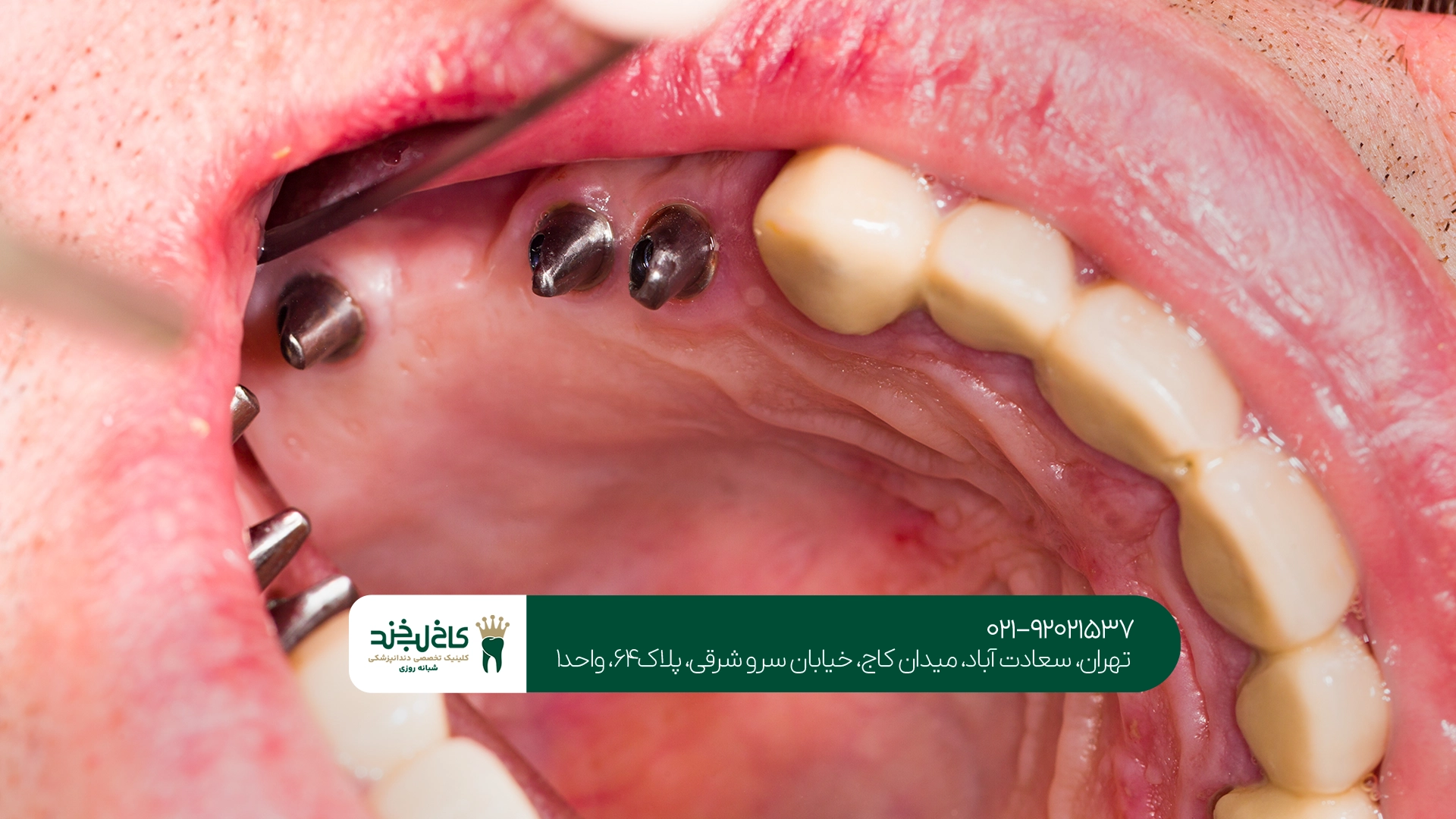 مراقبتهای ویژه ایمپلنت در افراد مسن مراقبتهای ویژه ایمپلنت در افراد مسن