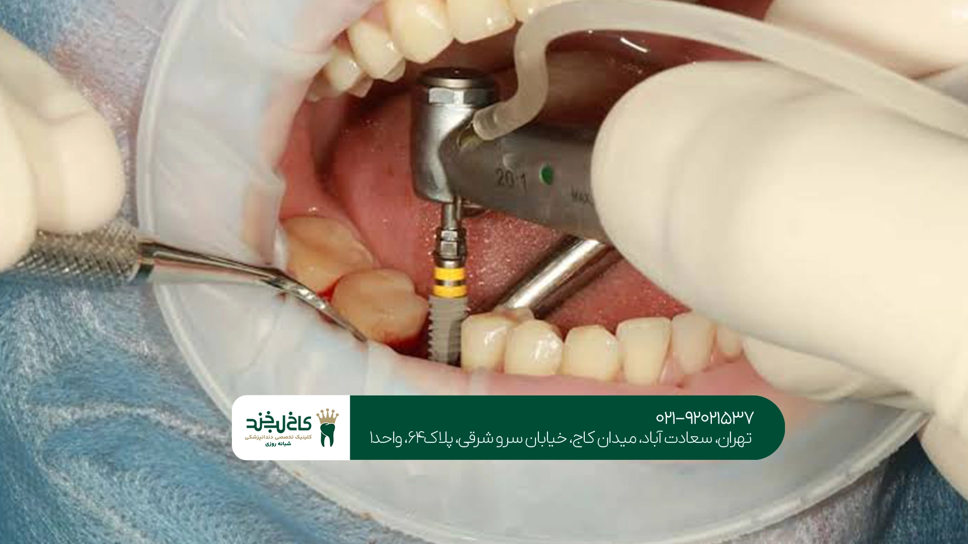 میزان موفقیت ایمپلنت در سنین بالا میزان موفقیت ایمپلنت در سنین بالا