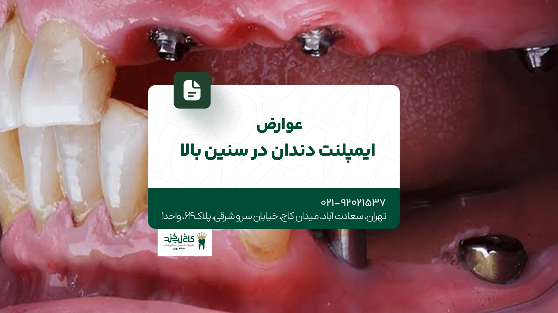 عوارض ایمپلنت دندان در سنین بالا عوارض ایمپلنت دندان در سنین بالا