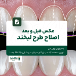 عکس قبل و بعد اصلاح طرح لبخند