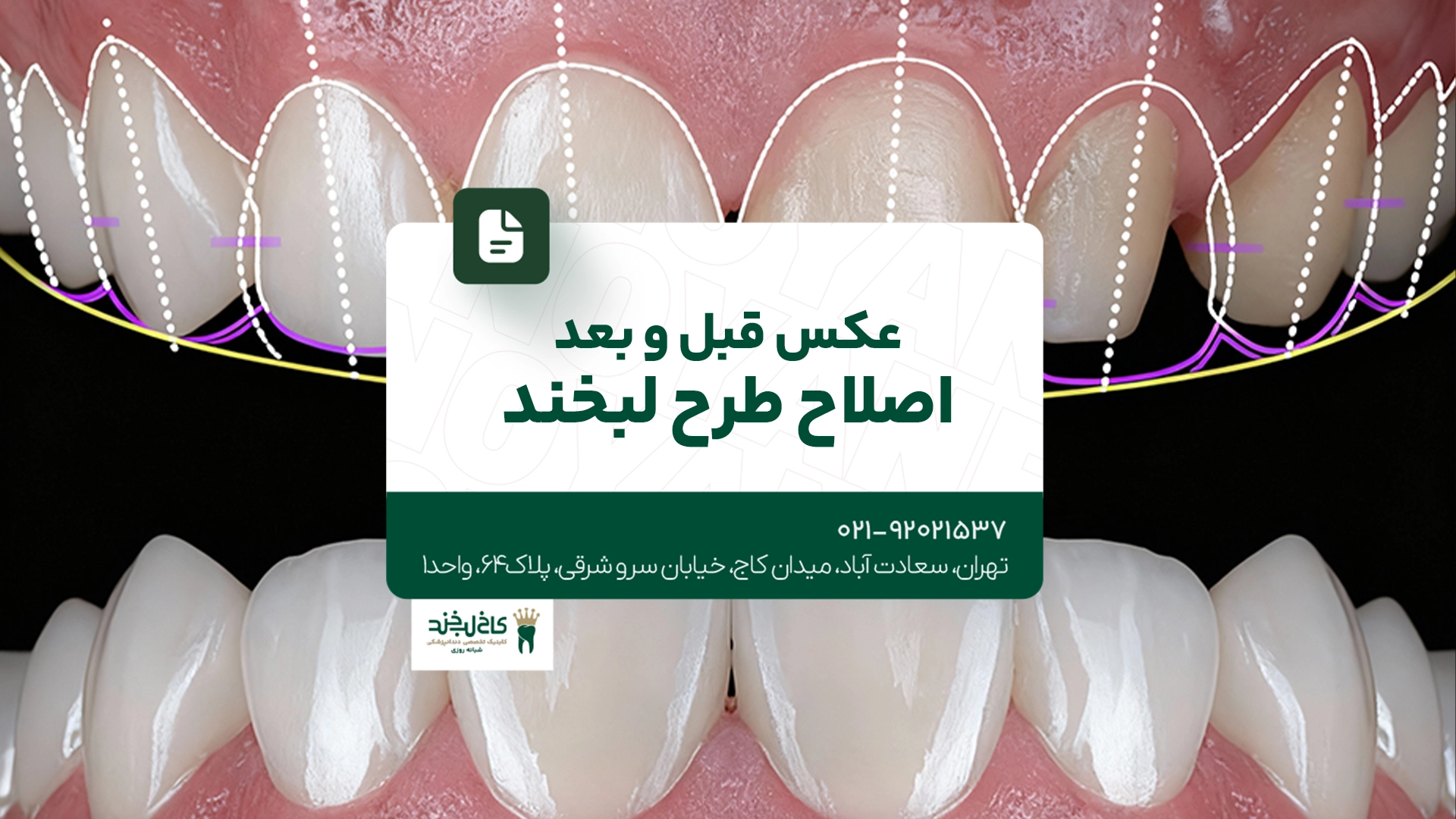 عکس قبل و بعد اصلاح طرح لبخند عکس قبل و بعد اصلاح طرح لبخند