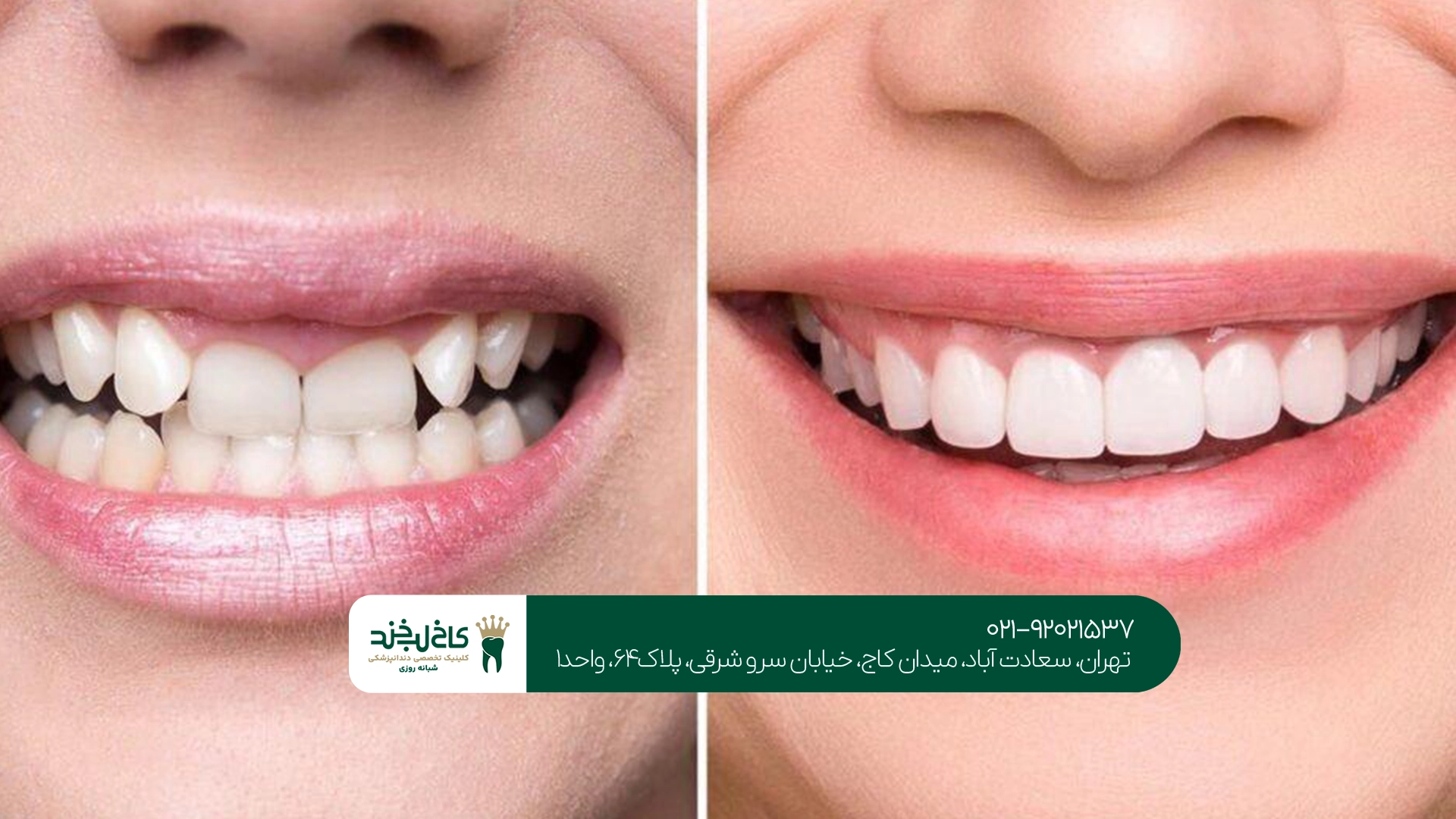 اصلاح طرح لبخند اصلاح طرح لبخند