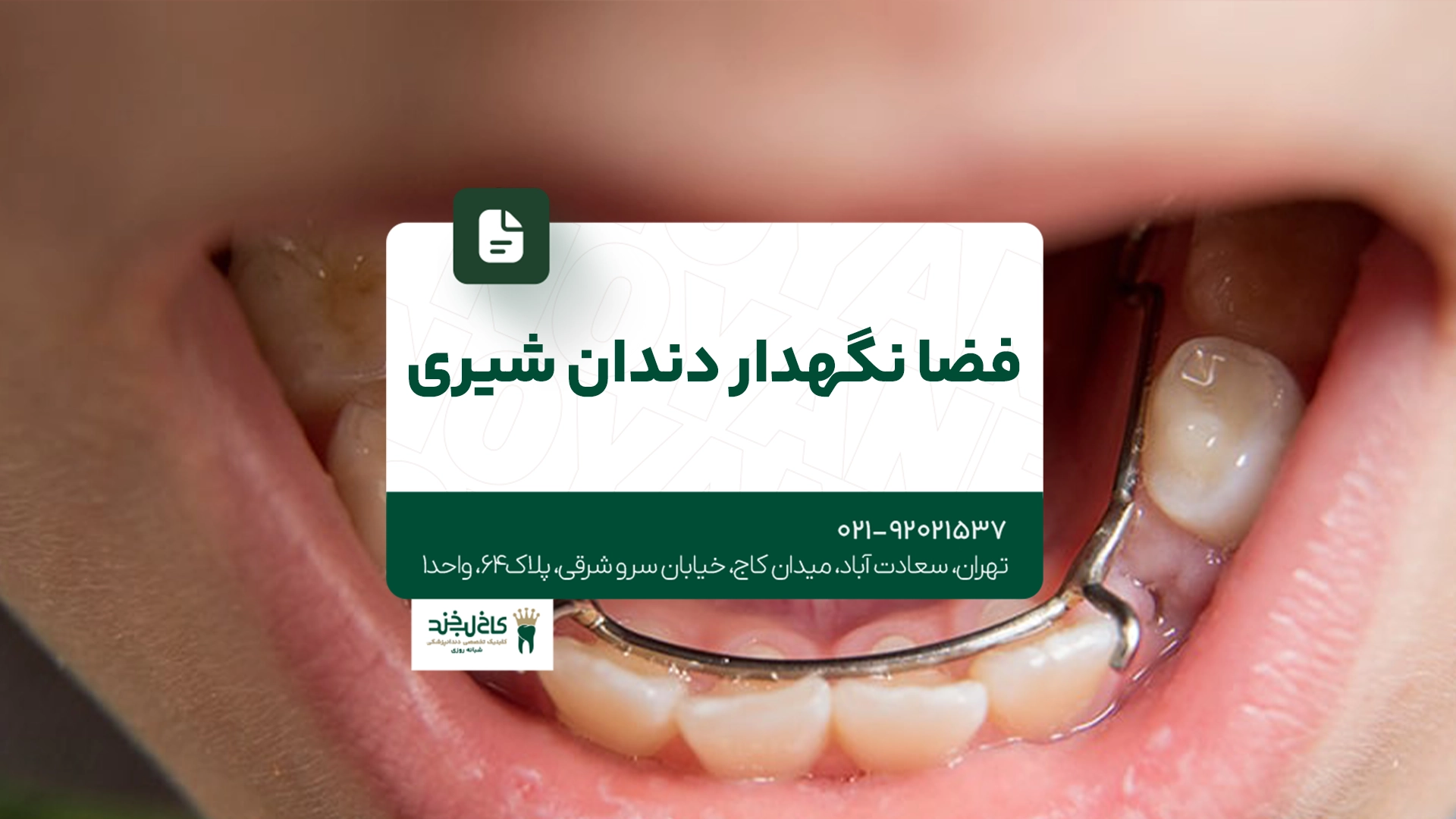 فضا نگهدار دندان شیری فضا نگهدار دندان شیری