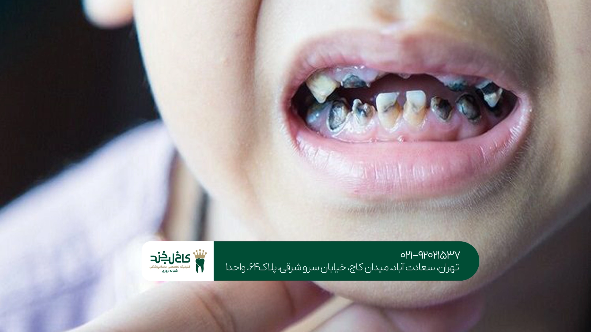 دندانپزشکی اطفال تهران