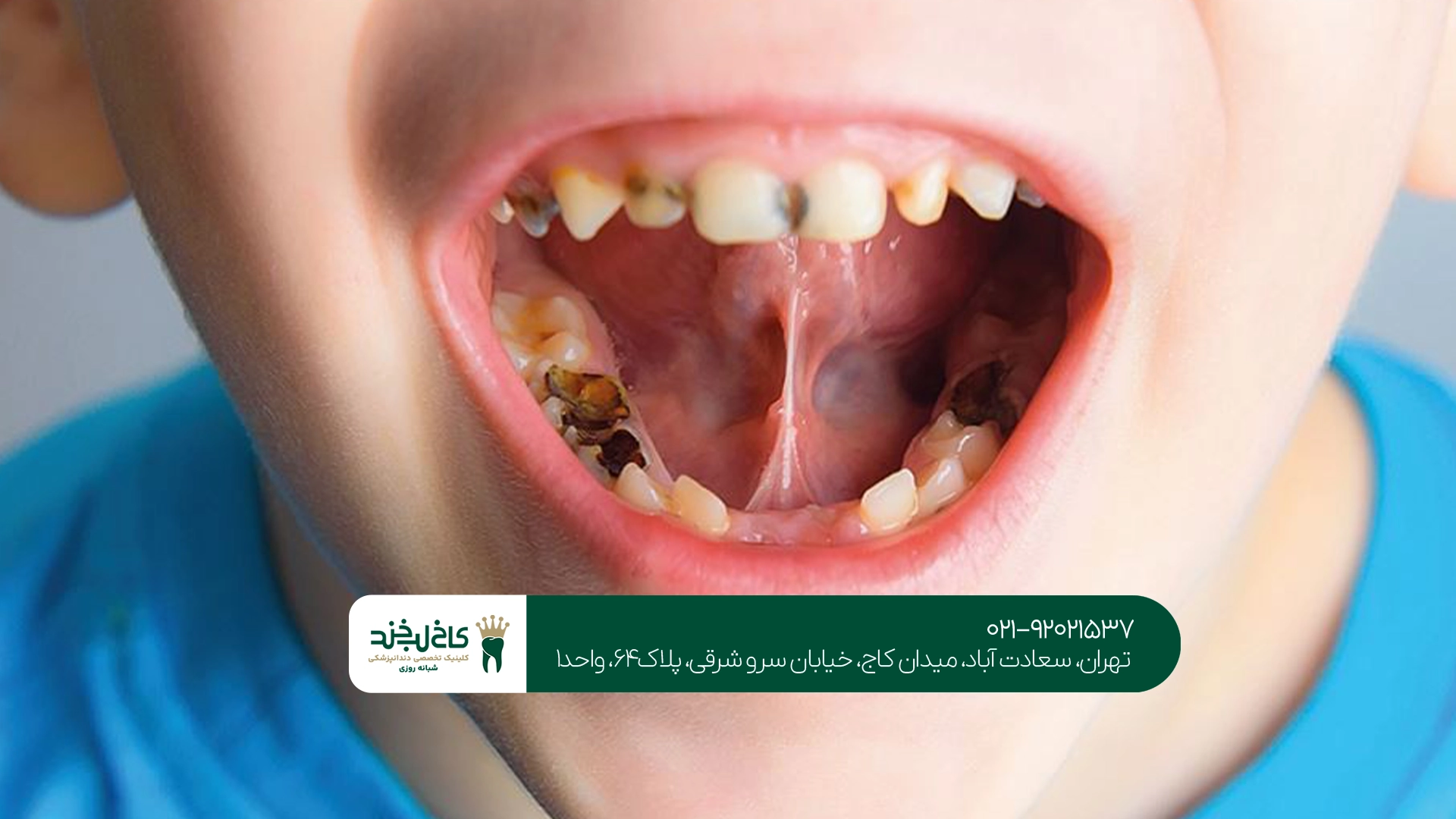 چگونه از دندان کودک بعد از مصرف قطره آهن مراقبت کنیم؟