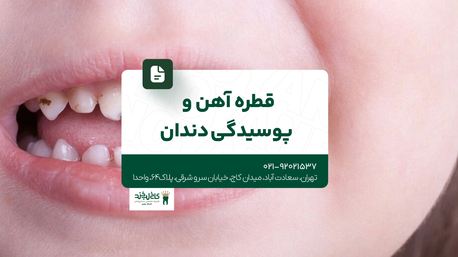 قطره آهن و پوسیدگی دندان