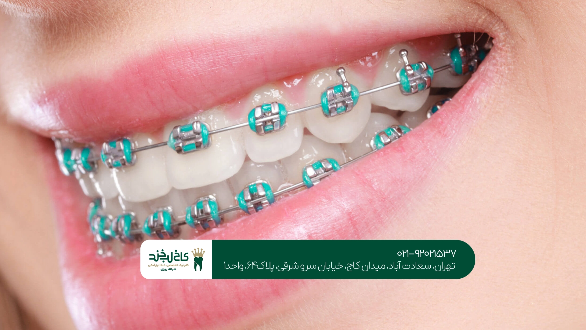 چه چیزهایی قیمت ارتودنسی را افزایش میدهد؟