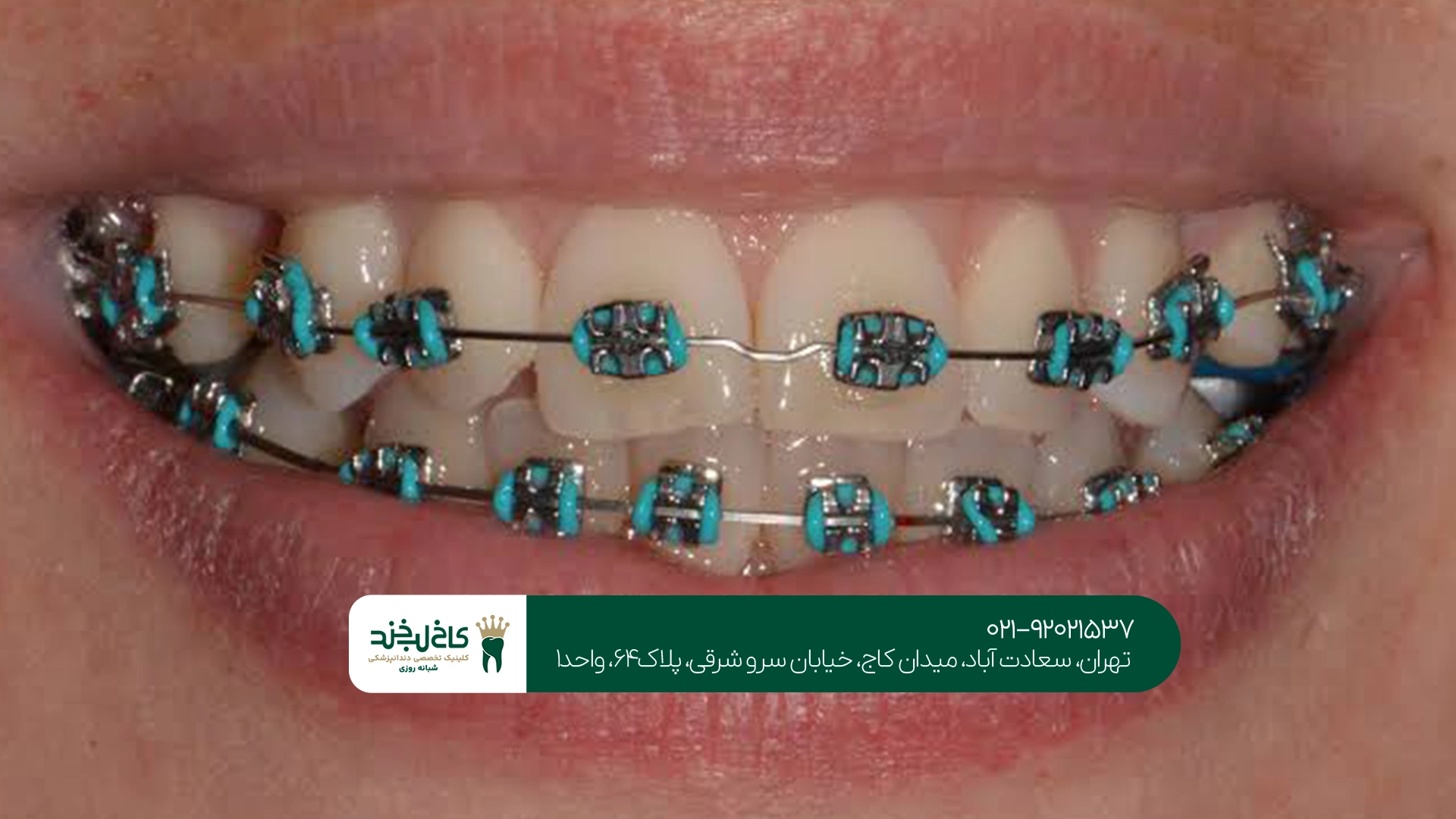 شرایط پرداخت ارتودنسی اقساطی چگونه است؟