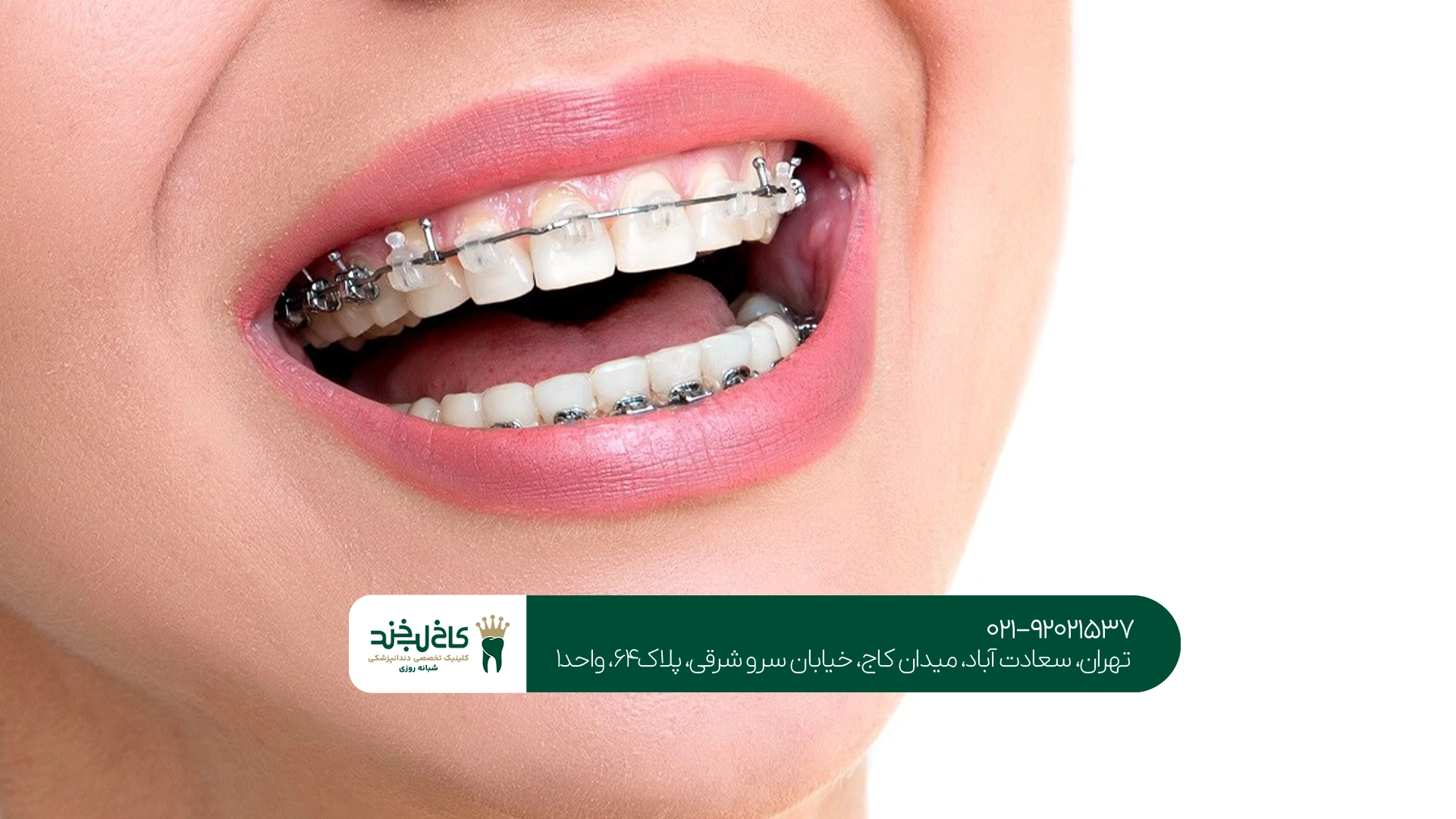 قیمت مناسب ارتودنسی دندان
