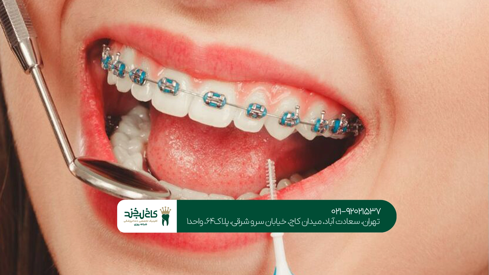 تفاوت قیمت ارتودنسی در سنین مختلف