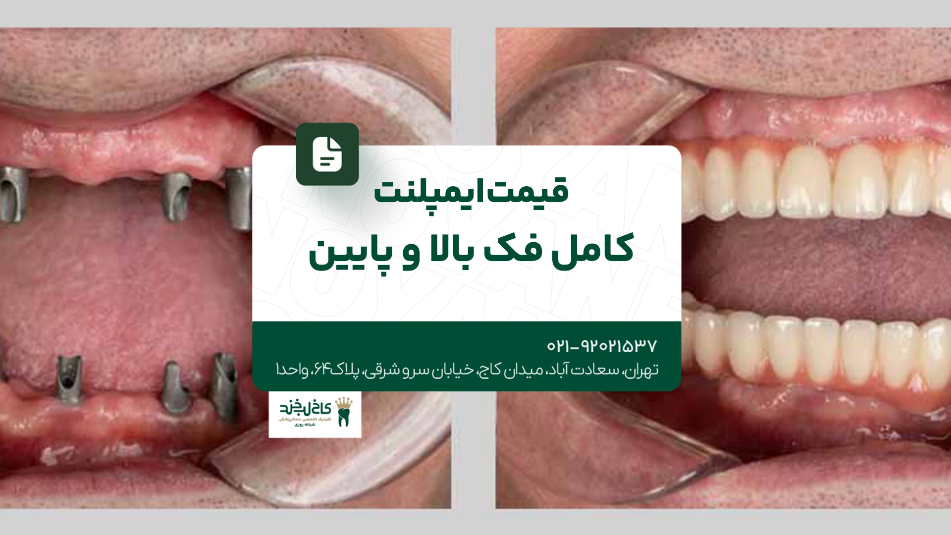 قیمت ایمپلنت کامل فک بالا و پایین