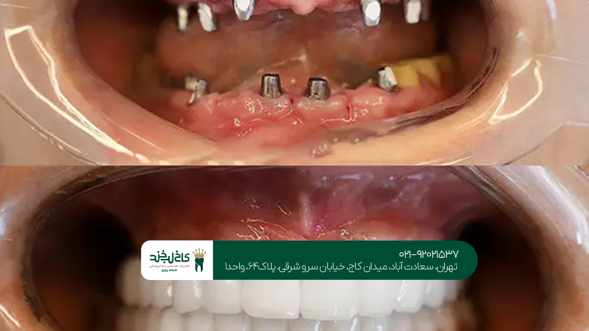 لبخند کامل با ایمپلنت فک بالا و پایین