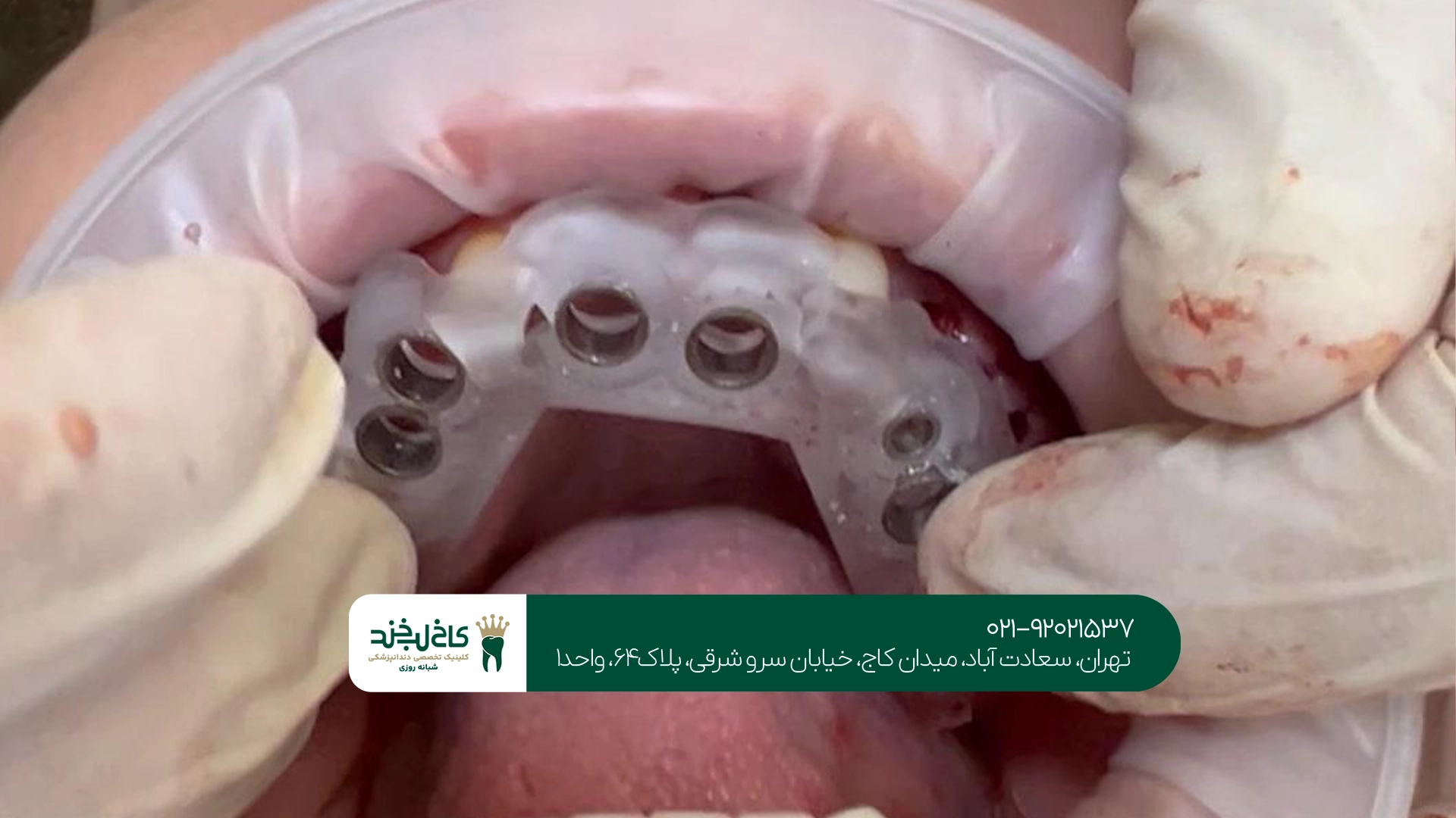 ایمپلنت کامل فک با شرایط اقساطی