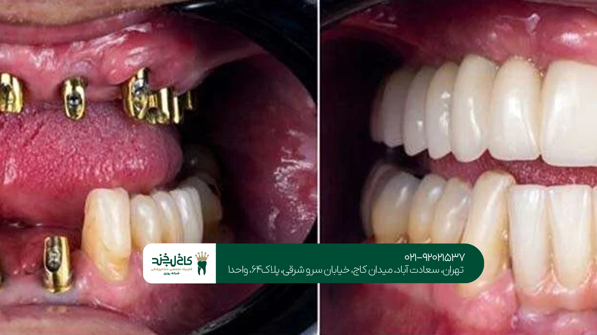 مراحل ایمپلنت کامل فک و تأثیر آن بر قیمت نهایی