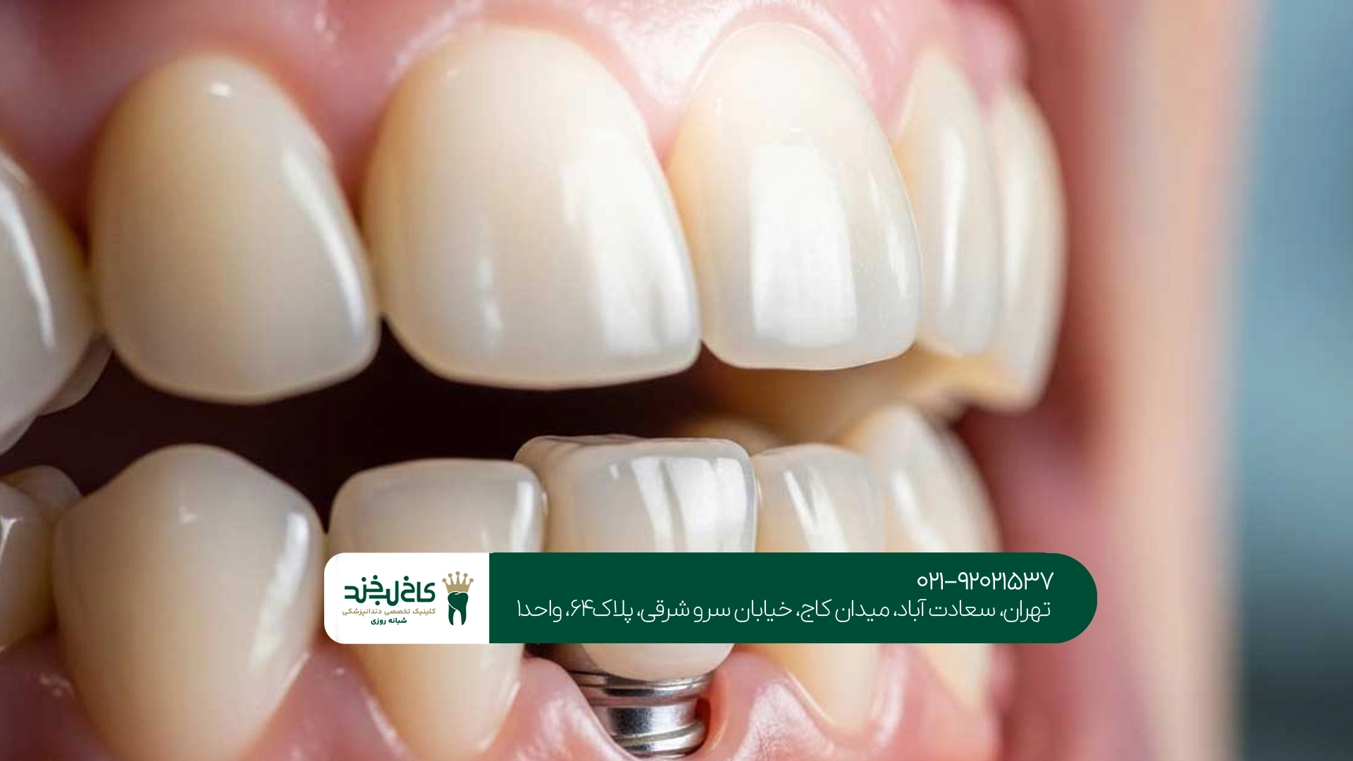 قیمت ایمپلنت کرهای قیمت ایمپلنت کرهای