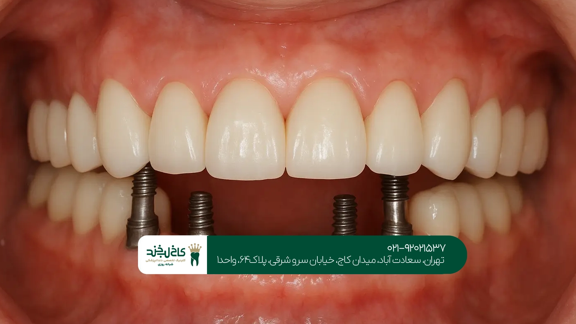 قیمت ایمپلنت کرهای قیمت ایمپلنت کرهای