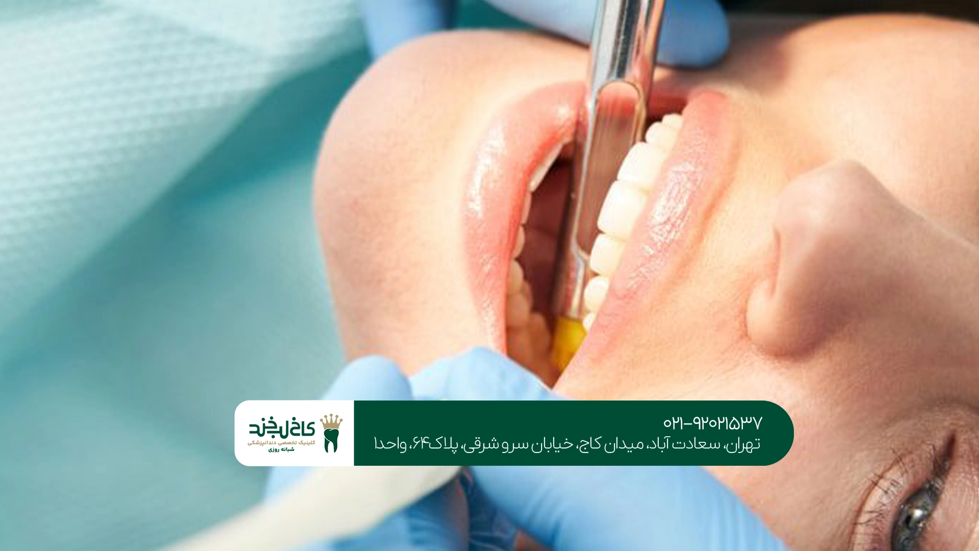 قیمت بلیچینگ دندان