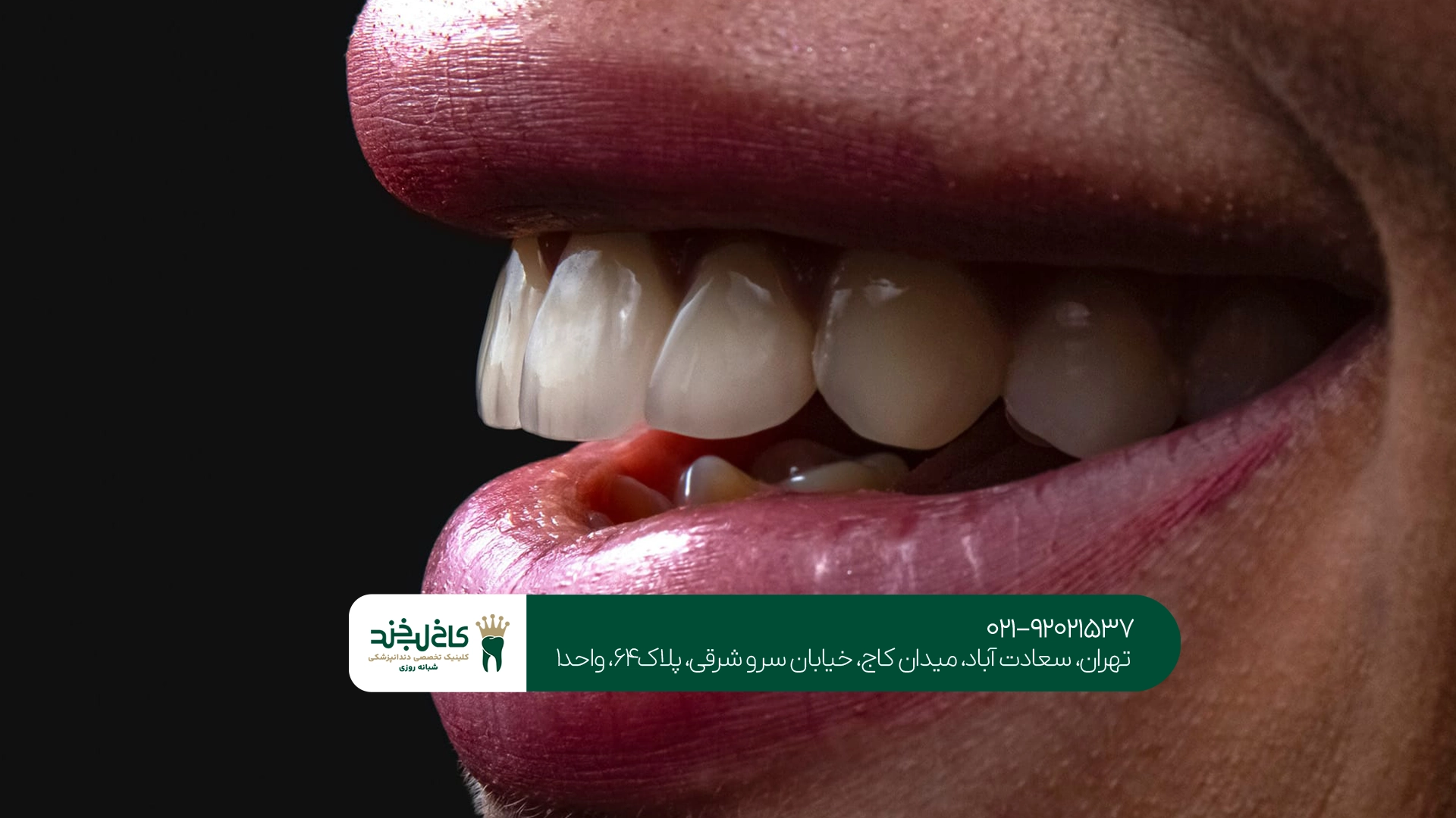 هزینه روکش زیرکونیا