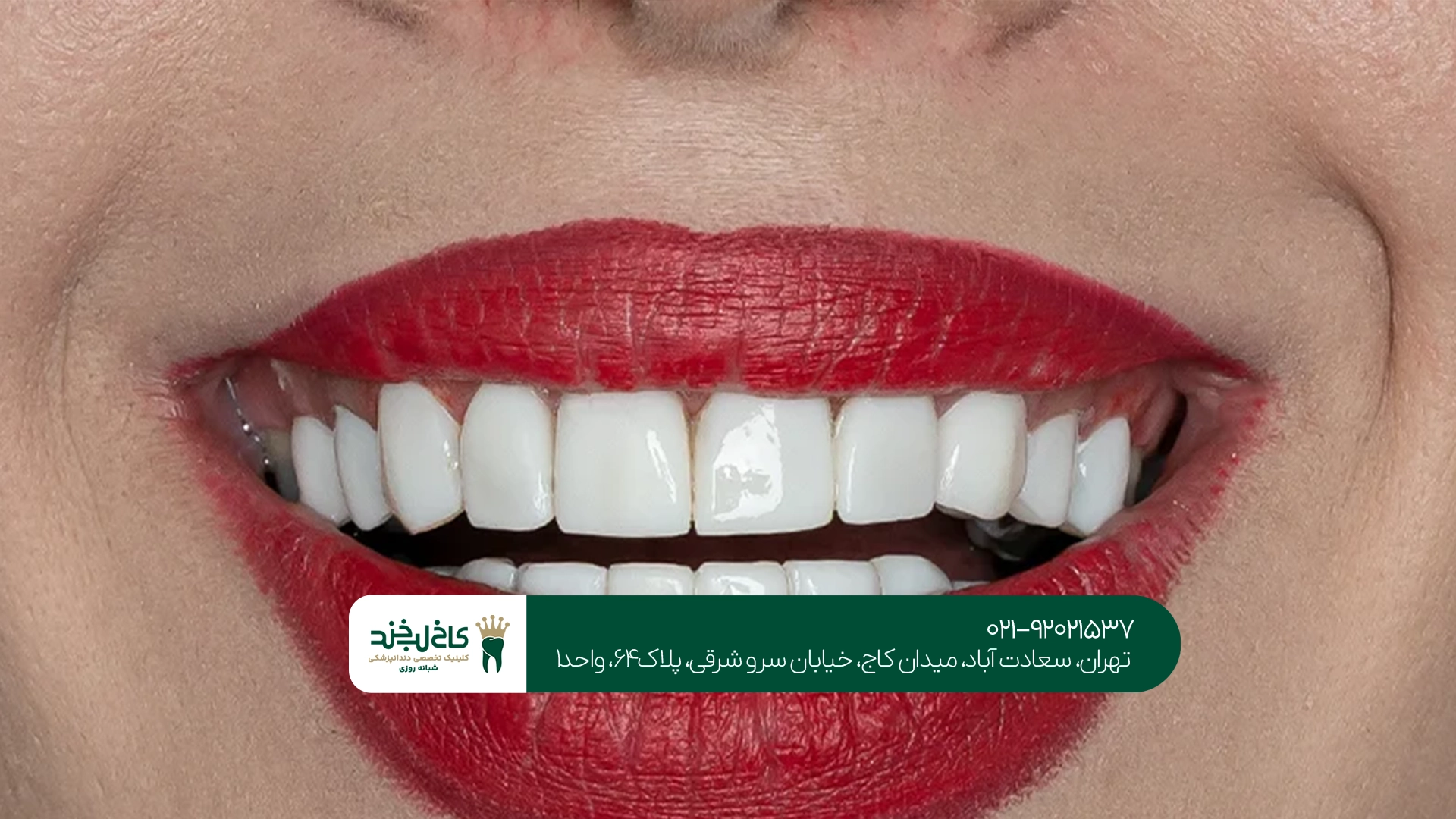 ماندگاری روکش زیرکونیا