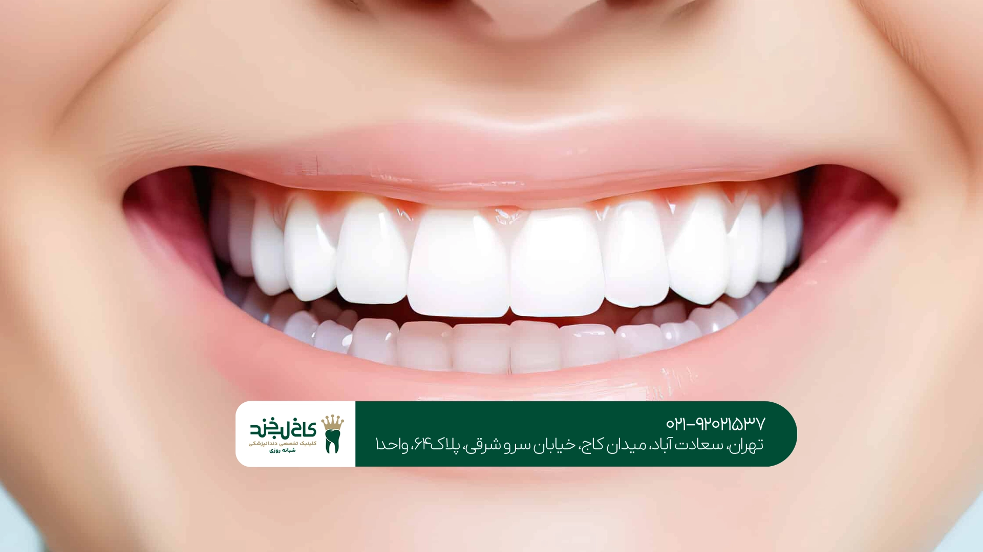 کامپوزیت دندان در سعادت آباد کامپوزیت دندان در سعادت آباد