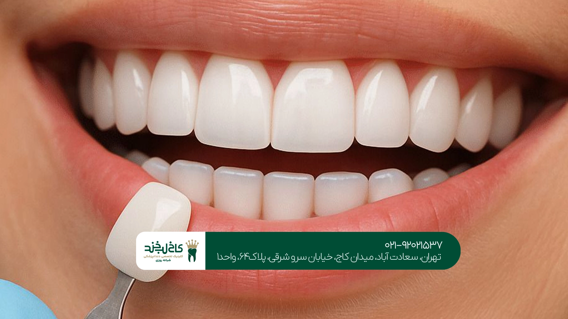 کامپوزیت دندان اقساطی تهران کامپوزیت دندان اقساطی تهران