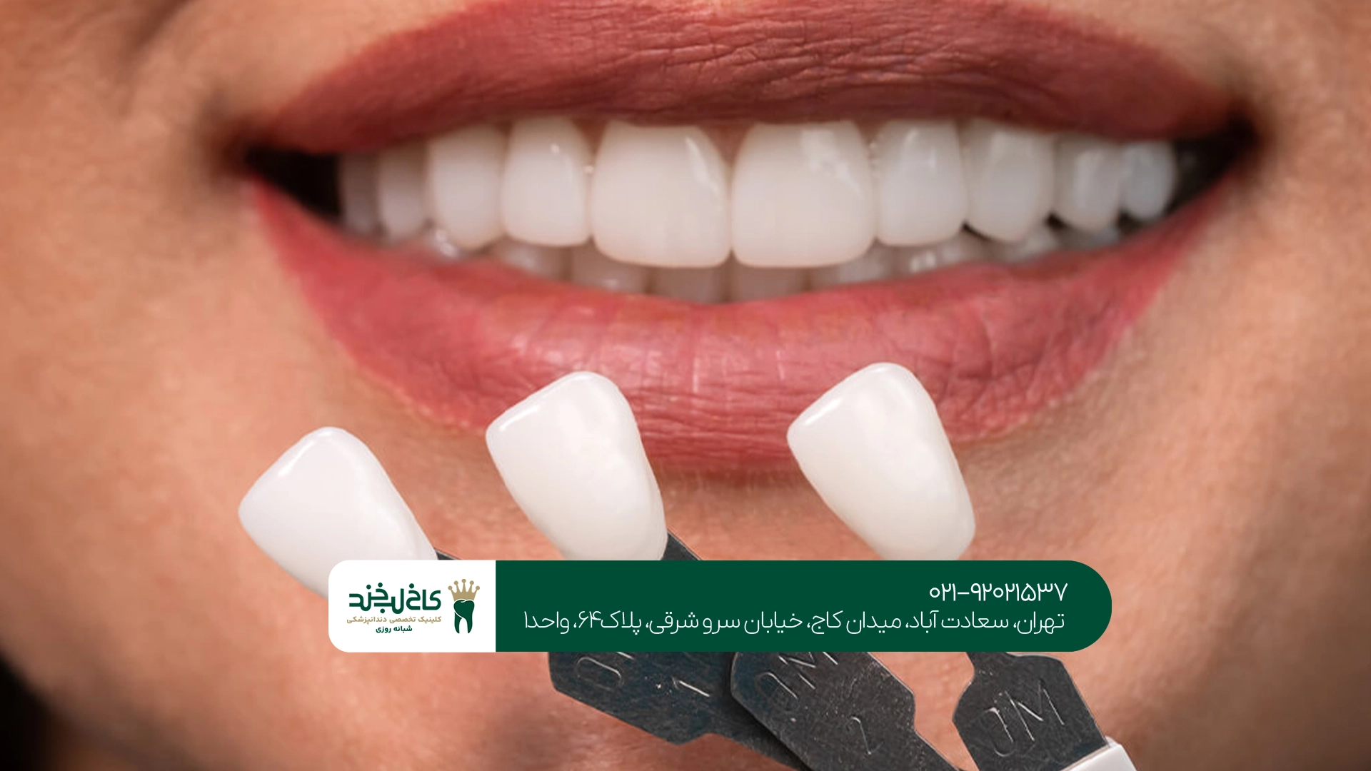 قیمت هر واحد کامپوزیت دندان قیمت هر واحد کامپوزیت دندان