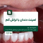 لمینت دندان با تراش کم
