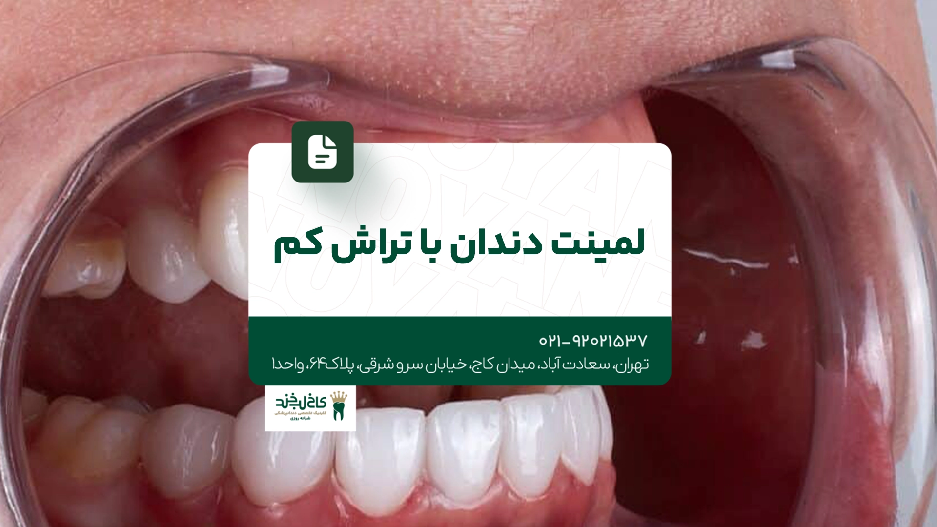 لمینت دندان با تراش کم
