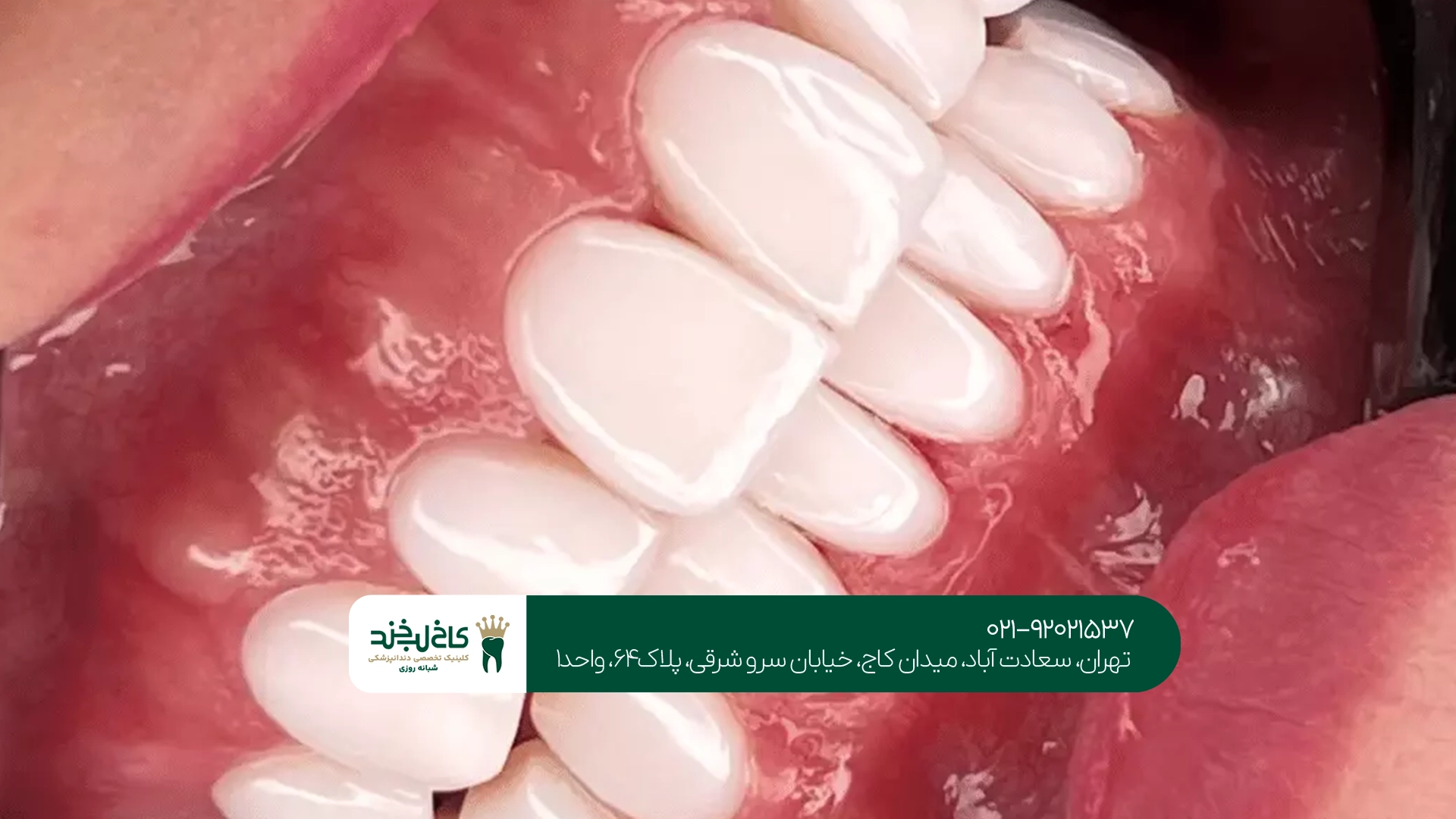 مراحل انجام لمینت دندان با تراش کم
