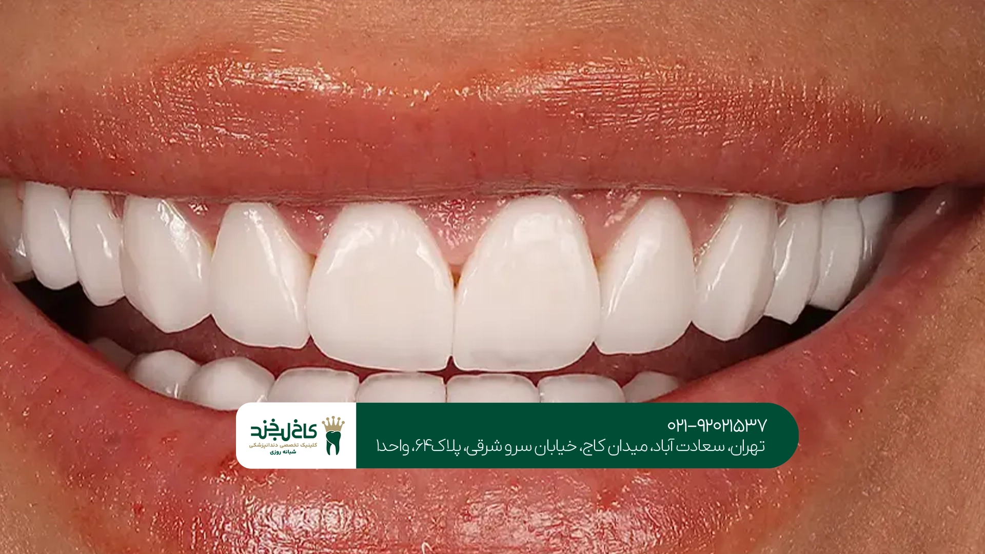 لمینت دندان طبیعی